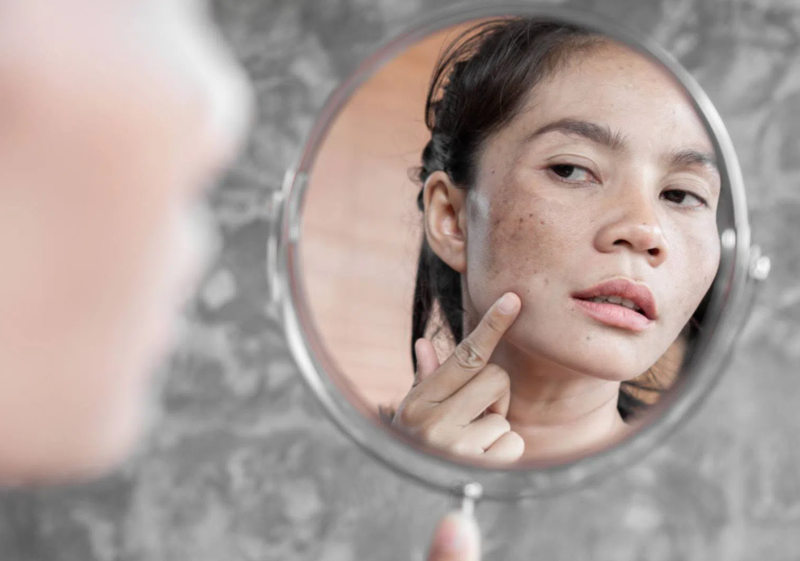 Nám là tình trạng tăng sắc tố thường xuất hiện ở má, trán và vùng quanh miệng 