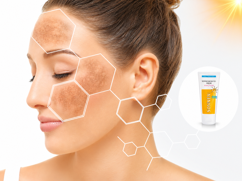 Người bị nám nên ưu tiên kem chống nắng phổ rộng SPF 30 trở lên và thoa lại khi tiếp xúc ánh nắng kéo dài